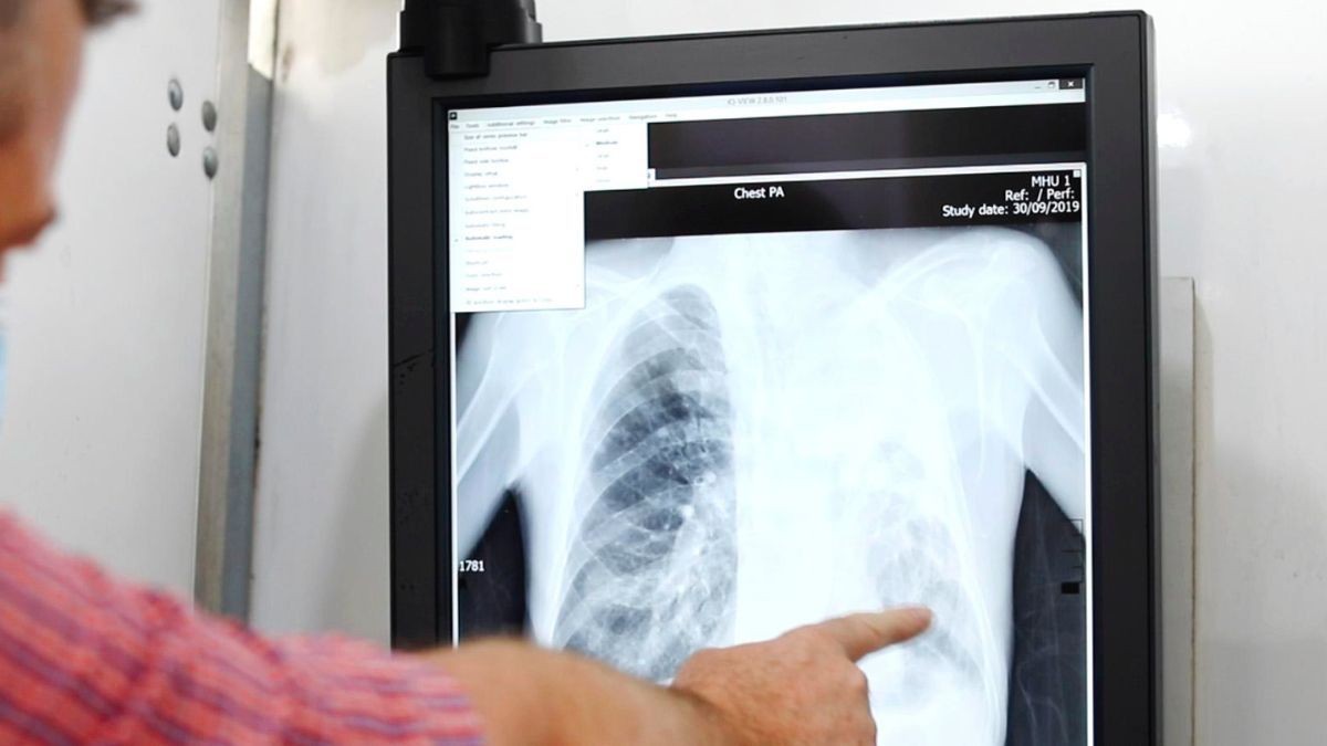 tuberculosis, QFT, TB